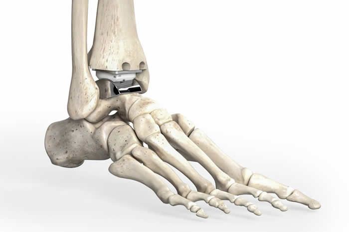 Total ankle Replacement